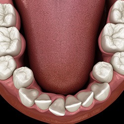 Illustration of crowded teeth