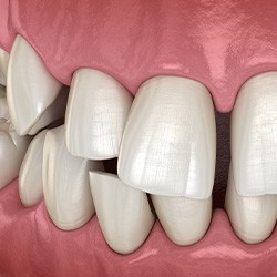 Illustration of gapped teeth
