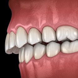 Illustration of an overbite