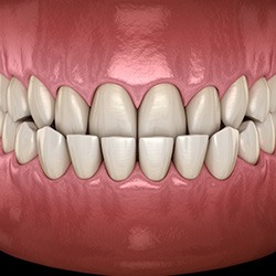 Illustration of an underbite