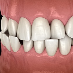 Illustration of a crossbite