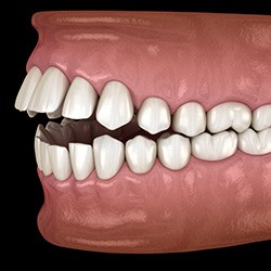Illustration of an open bite