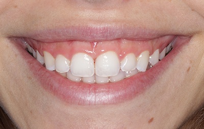 Alexis M after Diastema closure