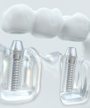Dental implant and bridge