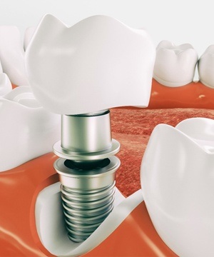 Diagram highlighting components of a dental implant in Jupiter