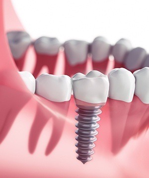 Diagram of an integrated dental implant in Jupiter