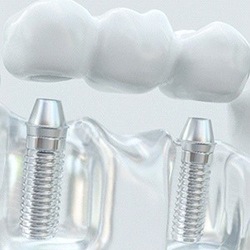 A dental bridge attaching to dental implants in Jupiter