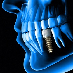 Diagram of an integrated dental implant in Jupiter