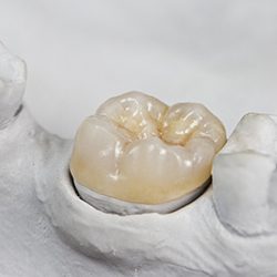 Crown for a dental implant in Jupiter in a model