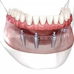 a 3D depiction of an All-on-4 denture