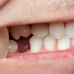 Closeup of a missing tooth