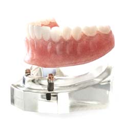 Implant dentures in Jupiter on white background