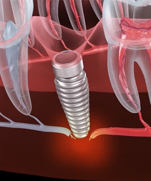 Illustration of a failed dental implant in Jupiter, FL