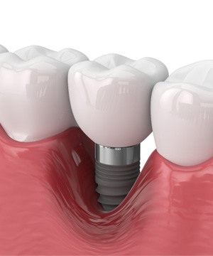 Illustration of a failed dental implant in Jupiter, FL