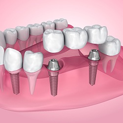 A 3D illustration of an implant bridge