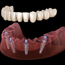 A 3D illustration of All-on-4 implants
