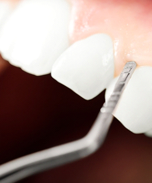 close up dental instrument checking gum pockets