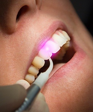 Closeup of smile during laser dental treatment