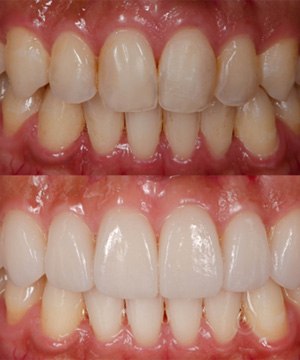 A before-and-after photo of a full mouth reconstruction in Jupiter  