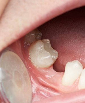 A missing tooth