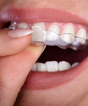 Closeup of someone removing clear aligners from upper arch