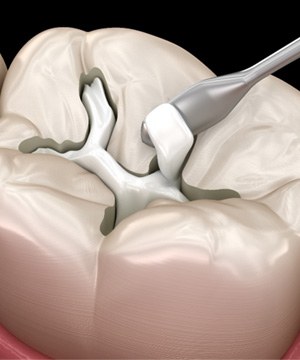 Digital view of a tooth-colored filling