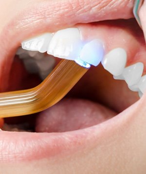 Curing light hardening tooth-colored filling 