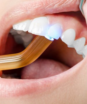 Curing light hardening tooth-colored filling