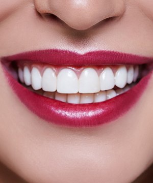 Smile with veneers in Jupiter