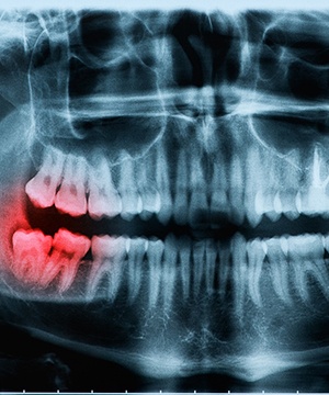 X-ray of wisdom teeth extraction in Jupiter