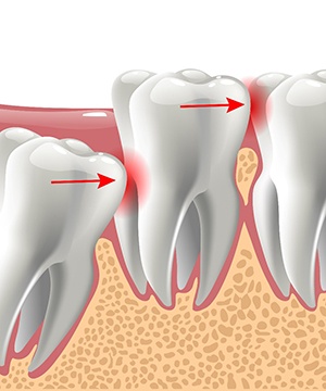 illustration of problematic wisdom tooth extraction in Jupiter 