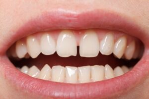 Gap between two front teeth.