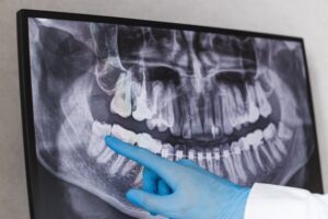 Dentist pointing at wisdom teeth in an X-ray